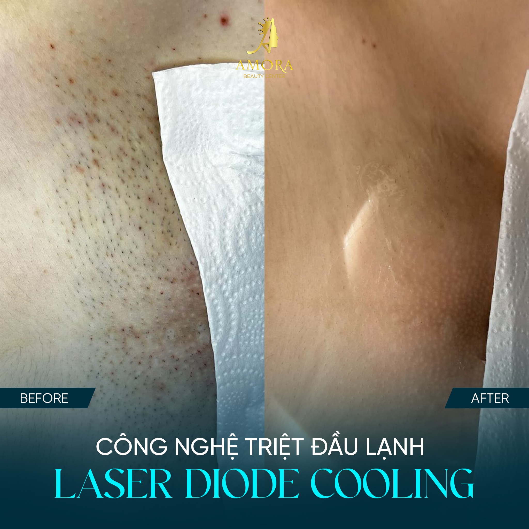 Kết quả triệt lông bikini tại amora