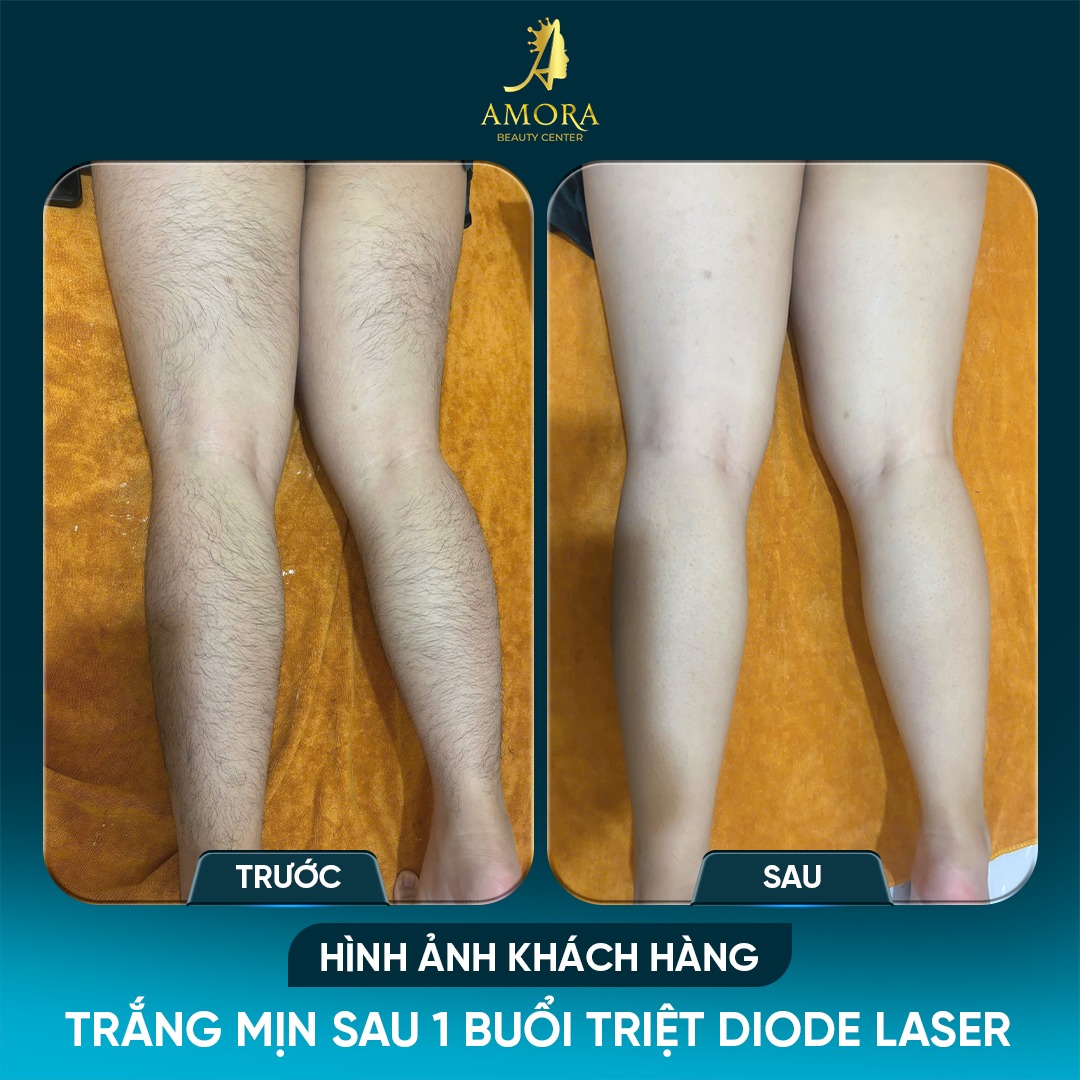 Kết quả sau khi triệt lông chân với công nghệ diode laser tại amora