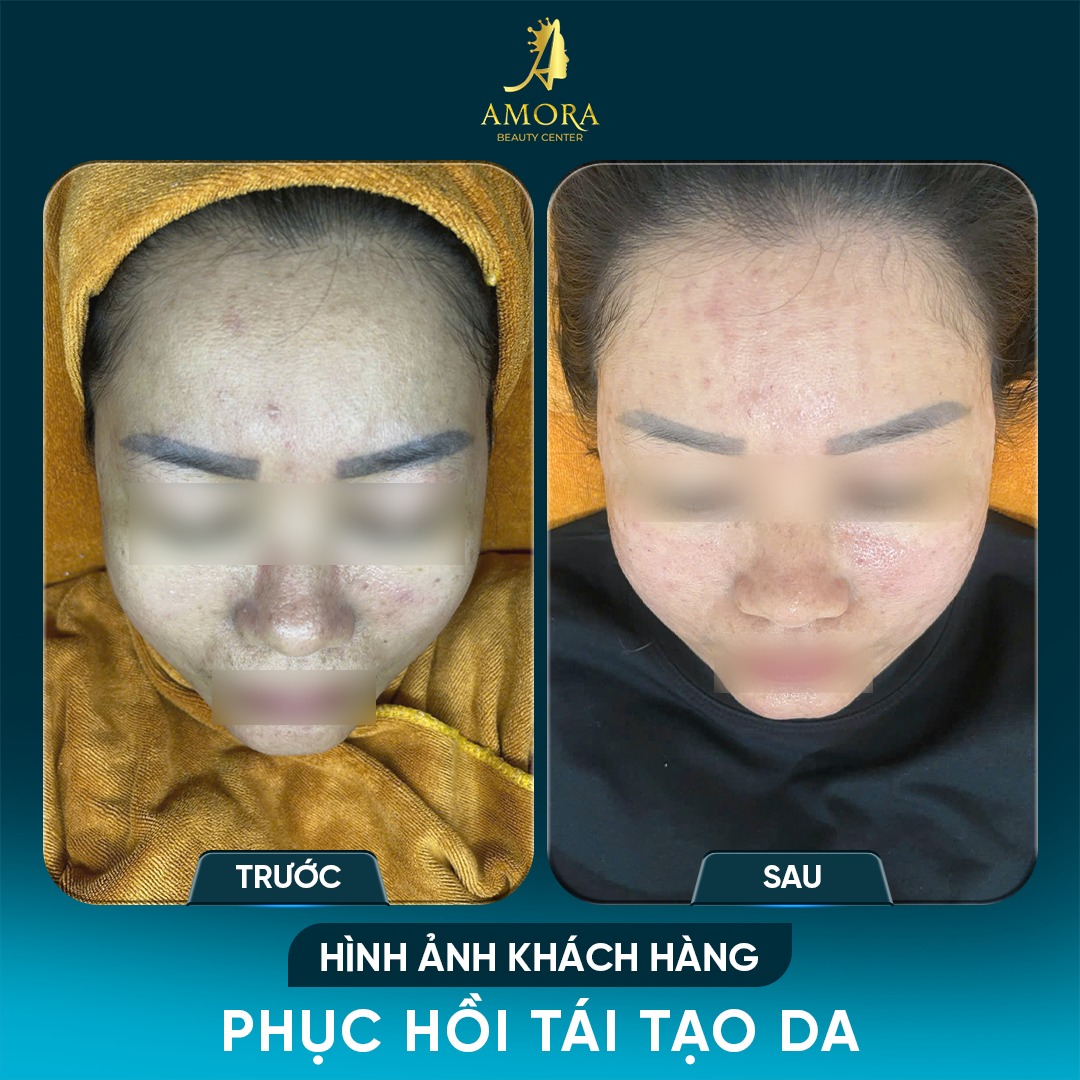 kết quả sau liệu trình trẻ hóa phục hồi da tại amora