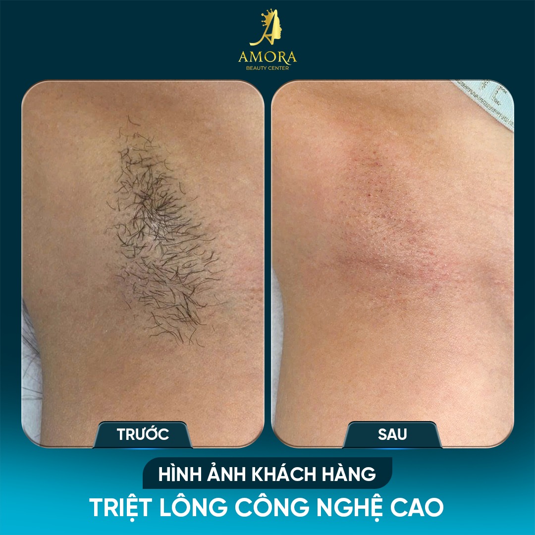 Kết quả triệt lông nách bằng công nghệ diode laser tại amora