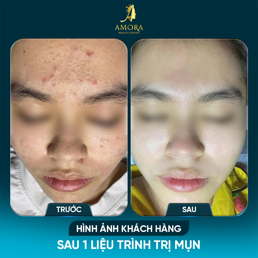 kết quả trước và sau liệu trình trị mụn tại Amora