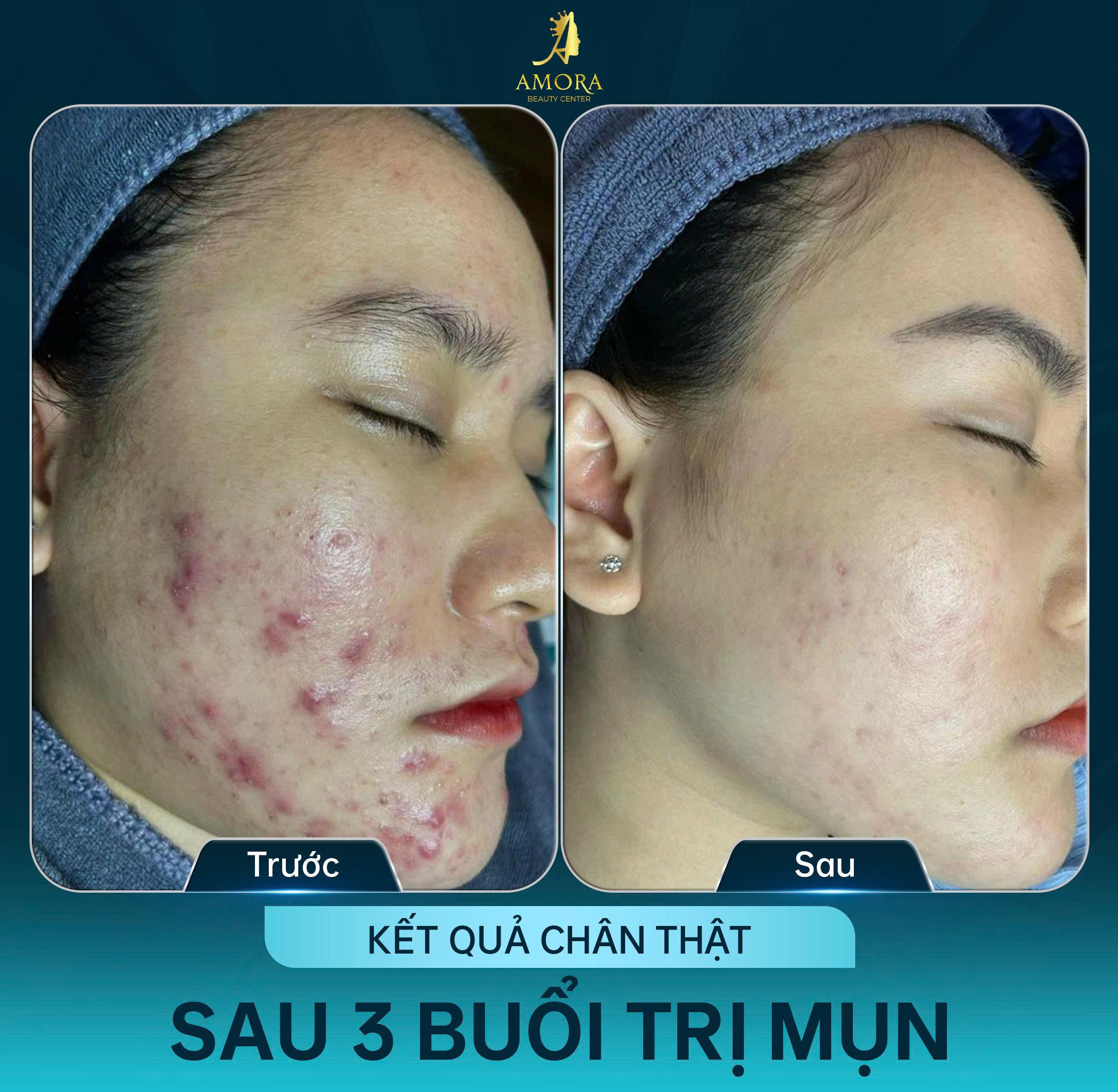 kết quả điều trị mụn sau 3 buổi tại amora